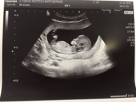 dating scan at 13 weeks 6 days